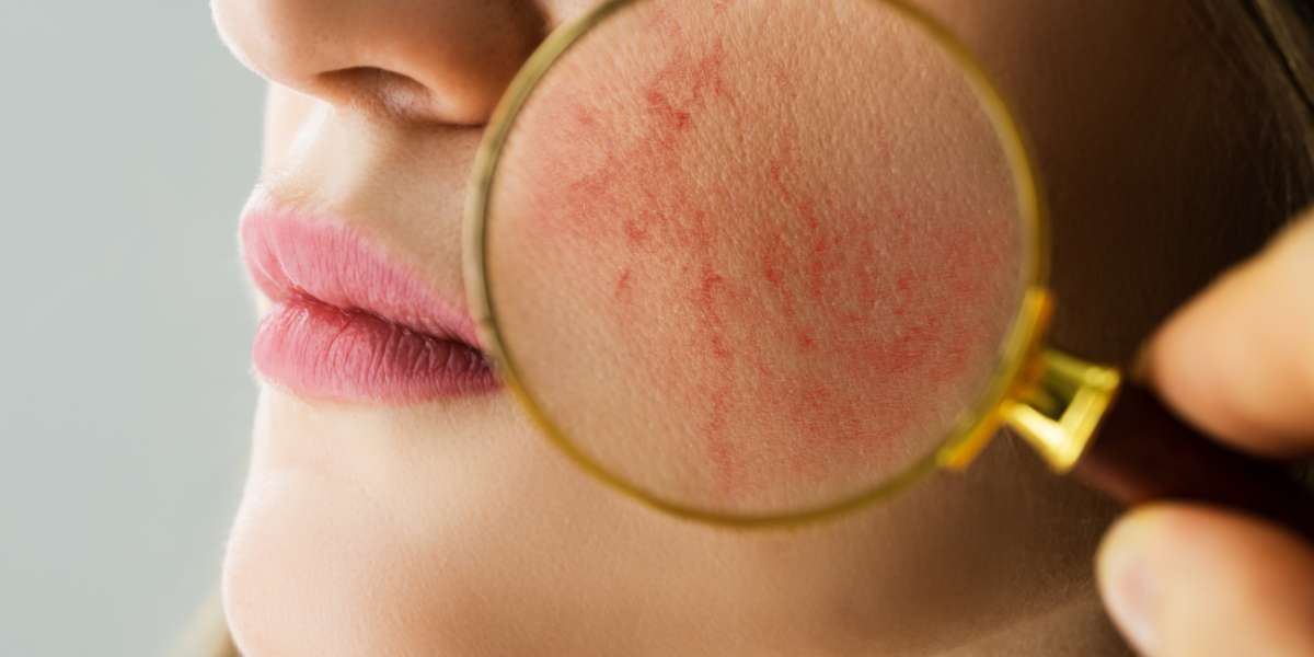 Óleo essencial para rosácea: tratamento natural e eficaz para a pele