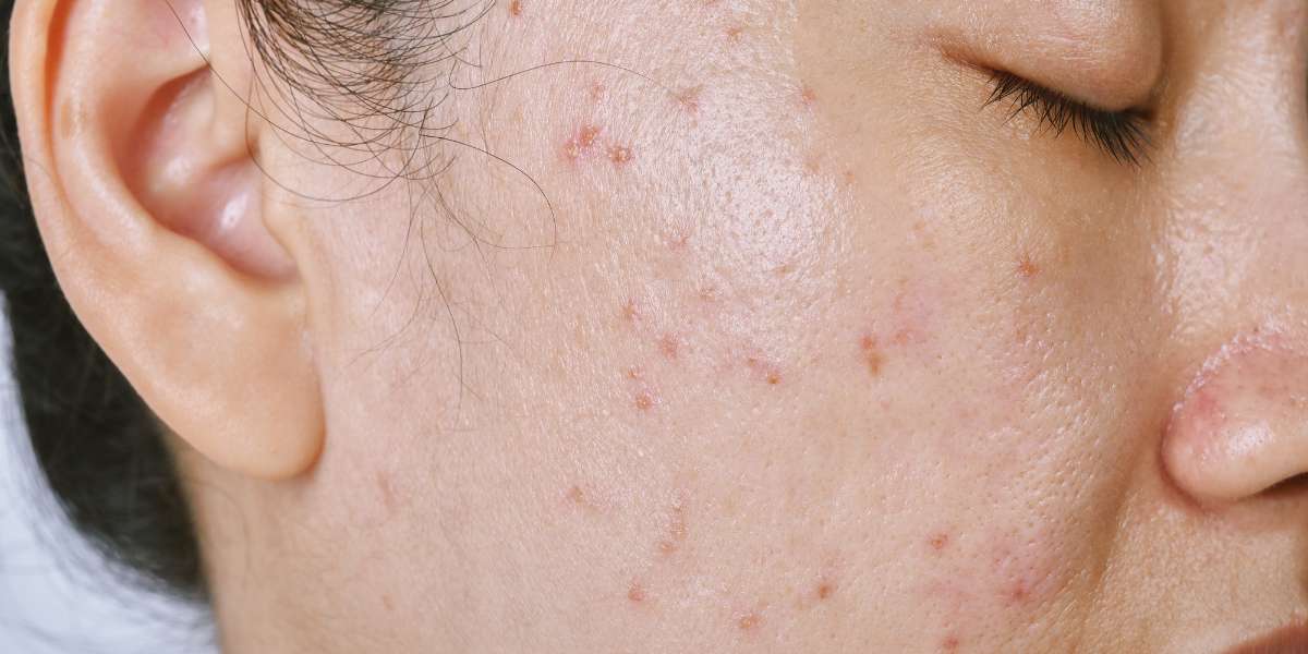 Óleo essencial para espinhas: Como usar e quais os melhores